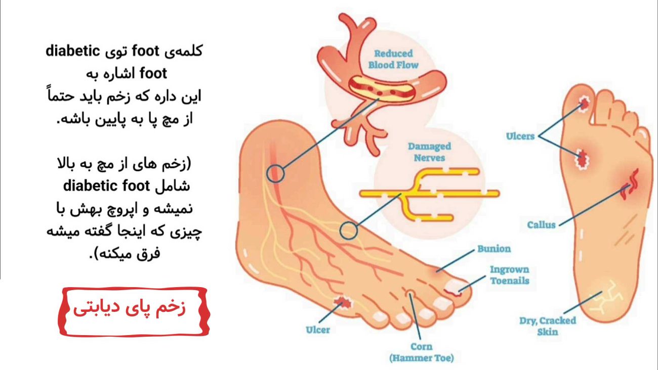 زخم پای دیابتی چیست و چگونه ایجاد می شود؟ 1 زخم پای دیابتی