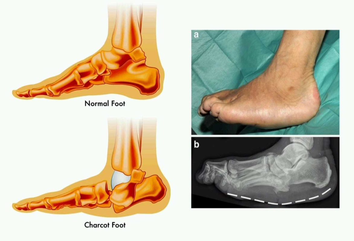 زخم پای دیابتی چیست و چگونه ایجاد می شود؟ 5 درمان زخم پای دیابتی