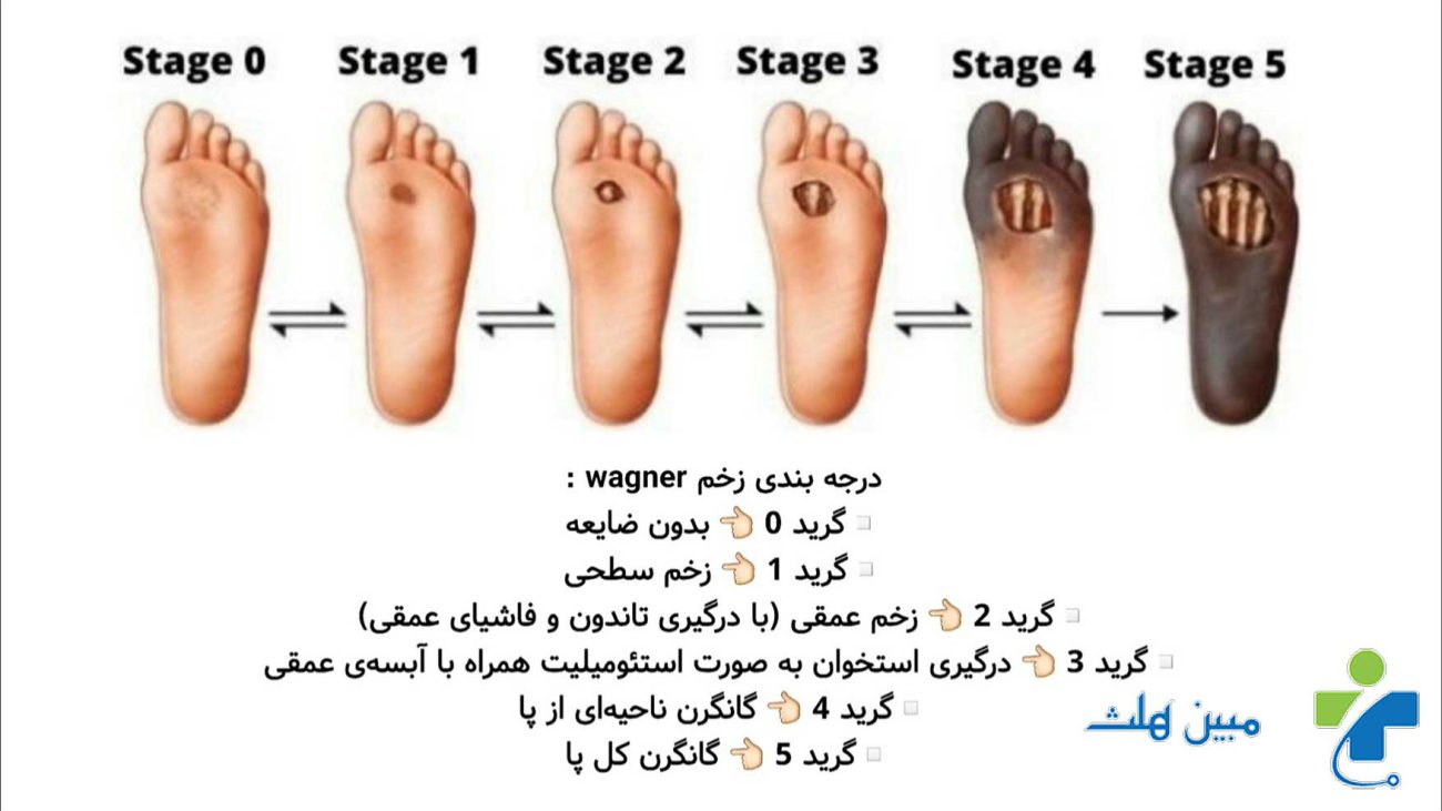 زخم پای دیابتی چیست و چگونه ایجاد می شود؟ 3 علائم زخم پای دیابتی