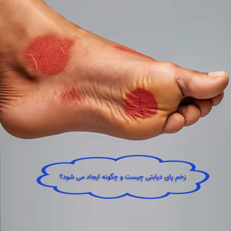 زخم پای دیابتی چیست و چگونه ایجاد می شود