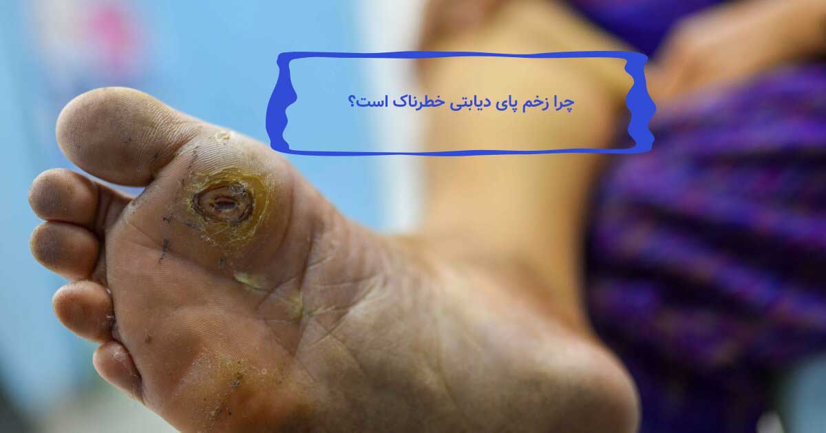 زخم پای دیابتی چیست و چگونه ایجاد می شود؟ 4 چرا زخم پای دیابتی خطرناک است؟