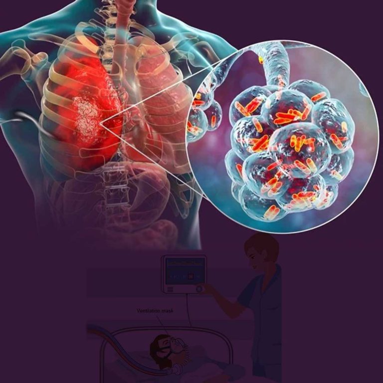پنومونی مربوط به استفاده از ونتیلاتور