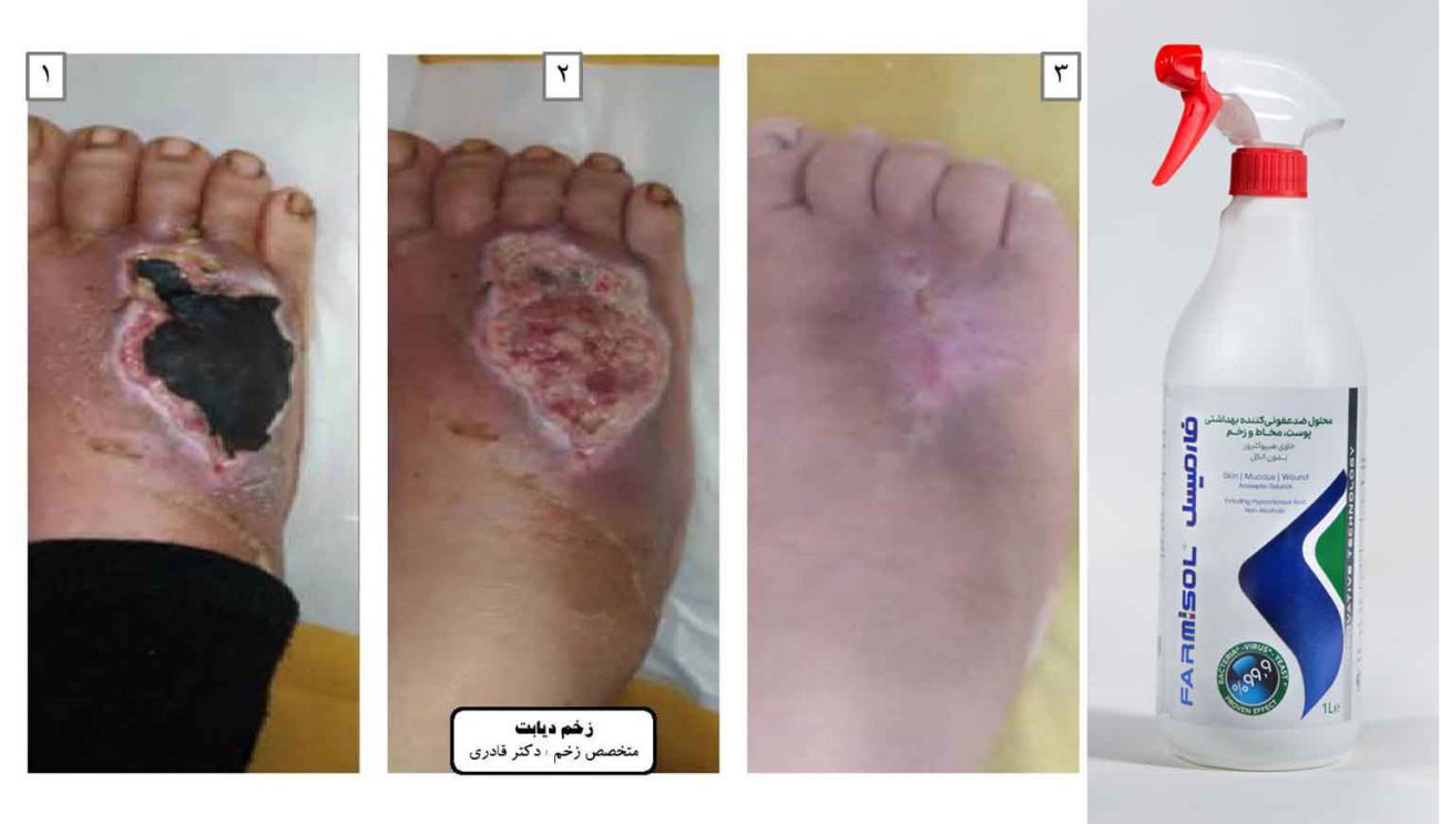 ضدعفونی کننده زخم پای دیابتی فارمیسل