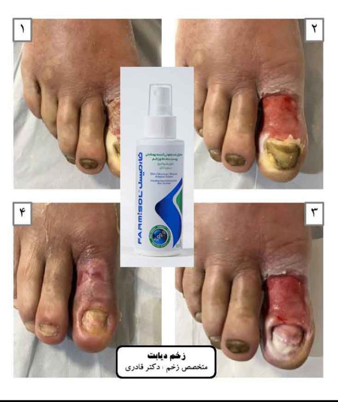 ضدعفونی کننده زخم فارمیسل